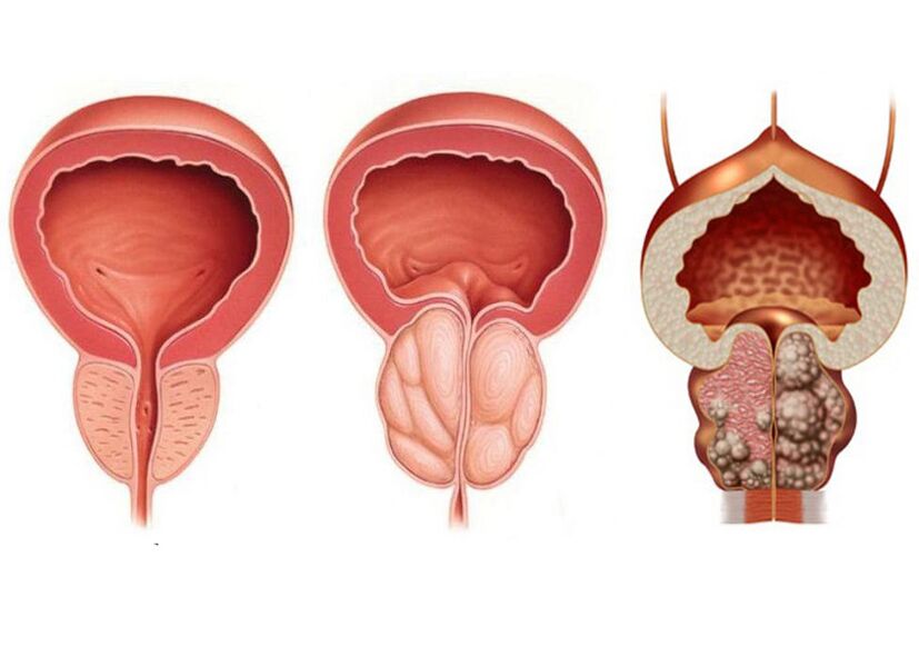 stopnje prostatitisa in potreba po zdravljenju s Prostavitom